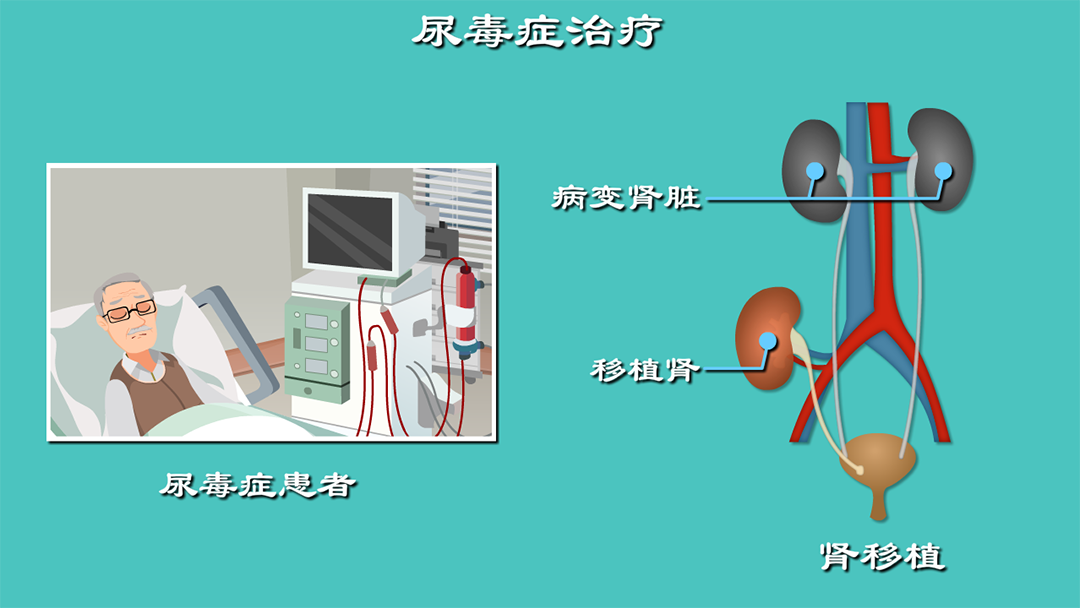 尿毒症 透析篇 3320